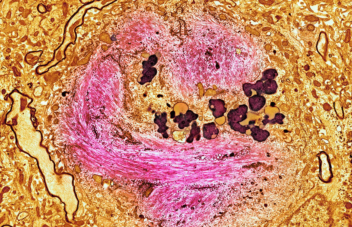 Újfajta hatóanyag segíthet az Alzheimer-kór lelassításában